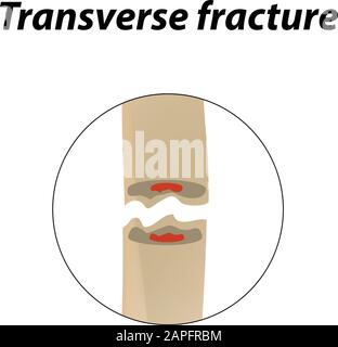 Frattura ossea trasversale. Infografiche. Illustrazione vettoriale su uno sfondo allineato. Illustrazione Vettoriale