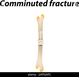 Frattura Ossea sminuzzata. Infografiche. Illustrazione vettoriale su uno sfondo allineato. Illustrazione Vettoriale