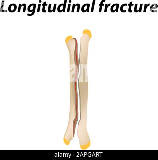Frattura ossea longitudinale. Infografiche. Illustrazione vettoriale su uno sfondo allineato. Illustrazione Vettoriale
