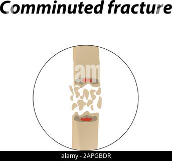 Frattura Ossea sminuzzata. Infografiche. Illustrazione vettoriale su uno sfondo allineato. Illustrazione Vettoriale