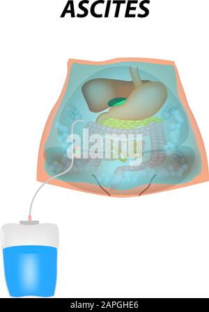 Ascite fluido libero nella cavità addominale. Infografiche. Illustrazione vettoriale su sfondo isolato. Illustrazione Vettoriale