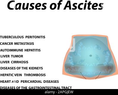 Ascite fluido libero nella cavità addominale. Infografiche. Illustrazione vettoriale su sfondo isolato. Illustrazione Vettoriale