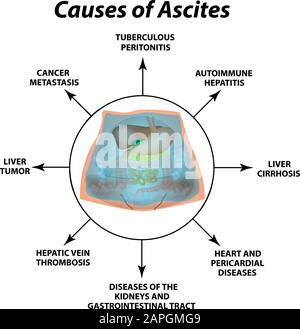 Ascite fluido libero nella cavità addominale. Infografiche. Illustrazione vettoriale su sfondo isolato. Illustrazione Vettoriale