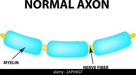 Assone normale. Mielina sana. Giornata Mondiale Della Sclerosi Multipla. Infografiche. Illustrazione vettoriale su sfondo isolato. Illustrazione Vettoriale
