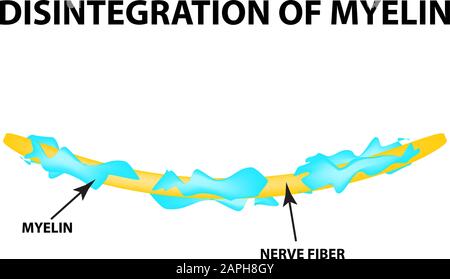 La distruzione della guaina mielinica sull'axon. Mielina danneggiata. Neurone affetto da sclerosi multipla. Giornata Mondiale Della Sclerosi Multipla. Infografiche Illustrazione Vettoriale