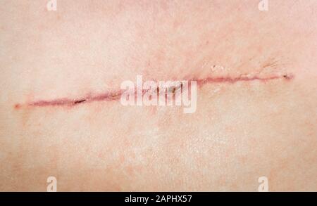 Una cucitura dopo un intervento chirurgico sulla pelle della schiena di una persona. Trapianto chirurgico di un lembo muscolare dalla parte posteriore. Fili autoassorbibili a ferita cucita, Foto Stock