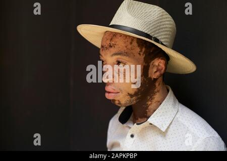 Ritratto di giovane uomo con vitiligo che indossa un cappello Foto Stock