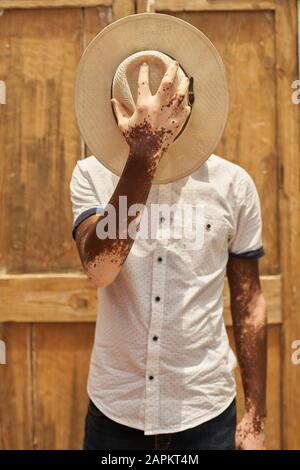 Ritratto di giovane uomo con vitiligo che copre il suo volto con un cappello Foto Stock