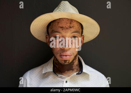 Ritratto di giovane uomo con vitiligo che indossa un cappello Foto Stock