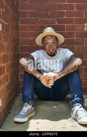 Ritratto di giovane uomo con vitiligo che indossa un cappello Foto Stock