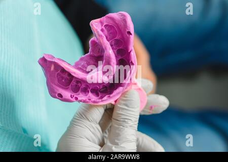 Il medico ortodontista nei guanti tiene un'impronta digitale per la dentiera viola Foto Stock