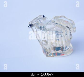 Dentisti dente modello in plastica con impianto a vite per l'insegnamento, apprendimento e pazienti in studio dentistico che mostra i denti e le gengive. Foto Stock