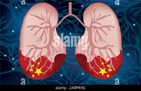 Lo scoppio del coronavirus mortale in Cina 2019-nCoV. Epidemie di polmonite a Wuhan 2019-2020, Cina. Anatomia dei polmoni. Illustrazione del vettore Illustrazione Vettoriale