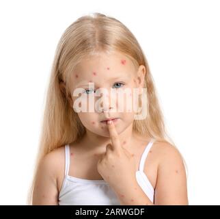 Bambina malata con varicella su sfondo bianco Foto Stock