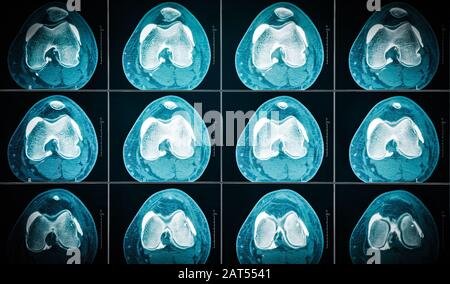 Scansione TC ginocchio sinistro danneggiata. Tagli orizzontali. Foto Stock
