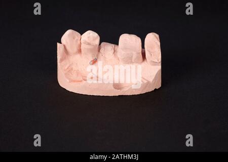 Sezione di calco in gesso dei denti superiori di sinistra del maschio umano di mezza età per produrre una corona dentale. Foto Stock