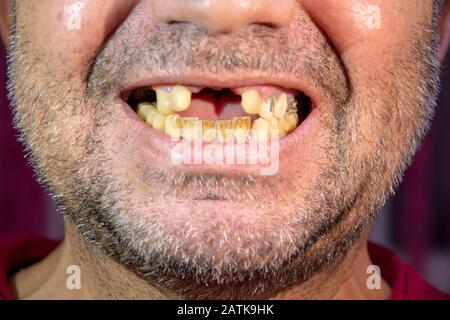 Uomo Senza Denti Foto Stock