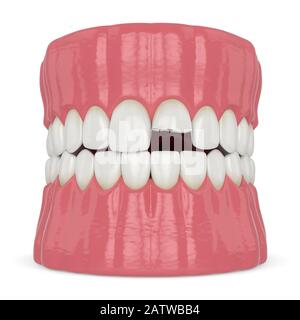 3d rappresentazione della mandibola con incisivo rotto dente superiore su sfondo bianco Foto Stock