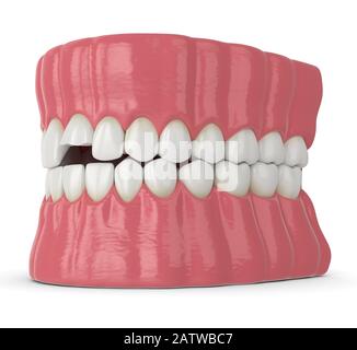 3d rappresentazione della mandibola con incisivo rotto dente superiore su sfondo bianco Foto Stock