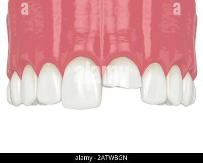 3d rappresentazione della mascella superiore con dente incisivo rotto su sfondo bianco Foto Stock