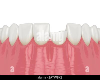 3d rappresentazione della mascella inferiore con dente incisivo rotto su sfondo bianco Foto Stock