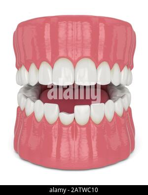 3d rappresentazione della mandibola aperta con incisivo rotto dente inferiore su sfondo bianco Foto Stock