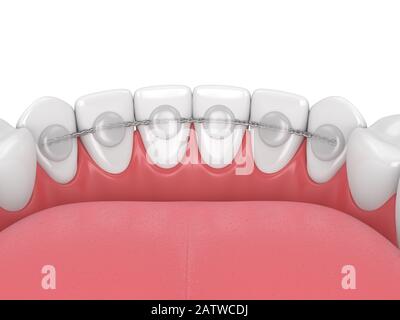 3d rendering del fermo dentistico incollato sulla ganascia inferiore su sfondo bianco Foto Stock