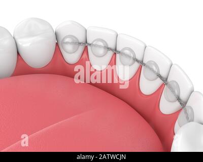 3d rendering del fermo dentistico incollato sulla ganascia inferiore su sfondo bianco Foto Stock