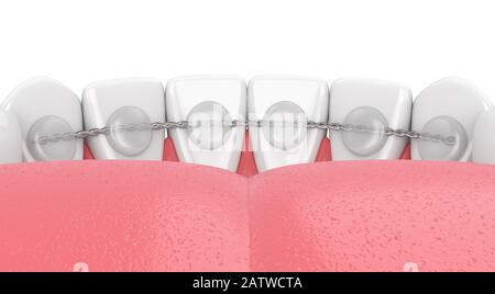 3d rendering del fermo dentistico incollato sulla ganascia inferiore su sfondo bianco Foto Stock