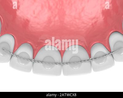 3d rendering del fermo dentistico incollato sulla ganascia superiore su sfondo bianco Foto Stock