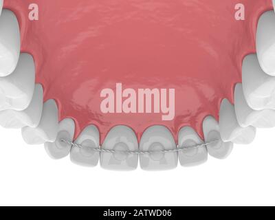 3d rendering del fermo dentistico incollato sulla ganascia superiore su sfondo bianco Foto Stock