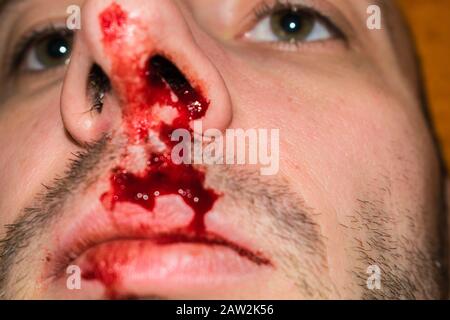 Naso rotto vicino. Il sangue dal naso scorre su una persona e sulla bocca. Il volto dell'uomo è nel sangue. Messa a fuoco selettiva Foto Stock