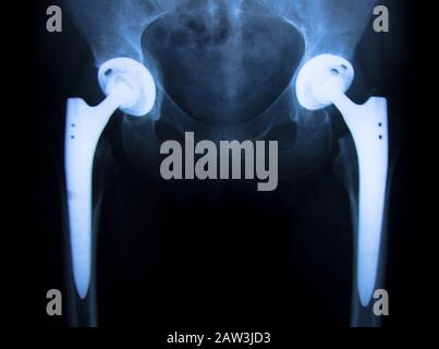 Sostituzione totale dell'anca, osteoartrite dell'articolazione dell'anca, articolazione artificiale dell'anca, dolore all'anca Foto Stock