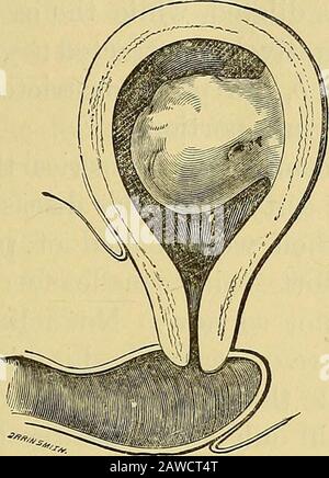 Note cliniche sulla chirurgia uterina : con particolare riferimento alla gestione della condizione sterile. L'utero si è rivelato essere ampliato, ma la os non era più grande del punto di una sonda connuun. È stata introdotta una piccola tenda spugnosa, e sul successivo un largerone. Questo dilatò sufficientemente il canale della cervice, ma il os ammise appena l'estremità del dito, andsentì come inelastico come se fosse legato da filo. Ovviamente, si potrebbe fare un ulteriore sforzo. Otto o dieci daysAfter questo siamo riusciti a dilatare la cervice, in modo da esplorare più soddisfacentemente la cavità dell'utero, Foto Stock