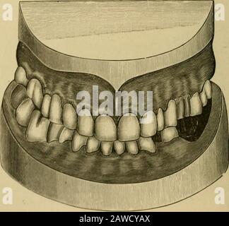 Un trattato pratico sulla corona artificiale e sul ponte . Fig. 373.. VASTA CORONA- E UUDOI.-LAVORO. 183 i restanti denti naturali superiori ed inferiori non avevano antagonisti corrisponenti, che causavano la condizione di interblocco e di abnor-male per quanto riguarda l'occlusione mostrata. Il bicuspide superiore destro, il centrale sinistro e la cuspide sinistra sono stati coronati, Fig. 374. Foto Stock