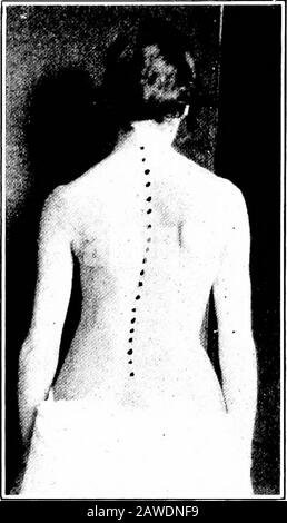 Anatomia applicata e chinesiologia, il meccanismo del movimento muscolare regione. Questo addestrerà i flessori dell'anca a mantenere il bacino dal ribaltamento troppo indietro. Inclinando indietro di 30 gradi rispetto alla posizione di seduta dovrebbe aiutare nella canalina. I muscoli del criceto sono atti ad essere un po 'corto e piegando il tronco lontano in avanti contribuirà ad allungarli. La scoliosi o la curvatura laterale della colonna vertebrale è una deviazione laterale della spina dorsale da una linea verticale retta. La presenza della rotazione 262 LA POSIZIONE ERETTA, che è stata spiegata in relazione ai movimenti del tr Foto Stock