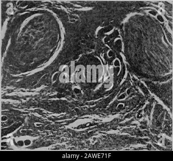 Documenti clinici e patologici .. come pure il flusso di siero. Storia successiva: Un anno dopo che è stato scaricato henoticed che un tumore sottocutaneo molle stava crescendo sulla destra nella regione occupata dalla crescita precedente. Non era mai doloroso o sensibile e la pigmentazione dello skinrestò lo stesso, anche se il capello coverijg è diventato grigio.On riammissione 2 maggio 1911, questo tumore misurato 8x3x1 cm.UNA seconda operazione di plastica è stato fatto dal Dr. G. W. Crile maggio Digitalizzato da Microsoft® Cole e Shawan- Malattia Di Von Recklinghausens 15 3, 1911. Come in altre operazioni su questo tipo Foto Stock