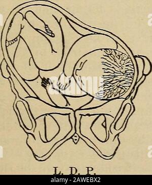 ObstetricsManuale per studenti e professionisti . R. D. A. diametro obliquo dell'utero a metà strada tra la verticale e ilverso: Quindi, la spalla, il gomito, o il braccio sono le parti fondanti. Vi sono quattro posizioni, vale a dire (1) sinistra dorso-anteriore, in Figura 29. Fig. 30.. Foto Stock