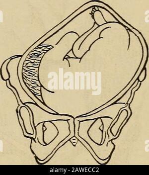 ObstetricsManuale per studenti e professionisti . L. D. A.. R. D. A. diametro obliquo dell'utero a metà strada tra la verticale e ilverso: Quindi, la spalla, il gomito, o il braccio sono le parti fondanti. Vi sono quattro posizioni, vale a dire (1) sinistra dorso-anteriore, in Figura 29. Fig. 30. Foto Stock