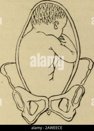 ObstetricsManuale per studenti e professionisti . L.S.A. RS.A. anteriormente e a sinistra della madre, e il diametro lungo delle anche giace nell'obliquo sinistro del bacino (Fig. 21). Fig. 23. Fig. 24. Foto Stock