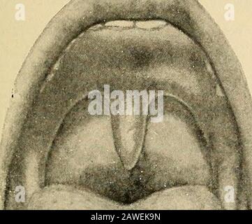 Chirurgia orale; un testo-libro su chirurgia generale e medicina come applicato al dentistry . itions, suchas l'exanthematema acuto, dove molta importanza è a-tach ai punti primari di Koplik sul buccal e labialmucosae nel morbillo, le vescicole e pustules nella bocca e faringe dei pazienti del vaiolo e della varicella, E somethto la lingua fragola e faringite in scarlatto febbre. Sulle mucose, tuttavia, le lesioni presentano pecu-liarità che non sono viste sulla pelle, rendendo la questione della diagnosi più complicata. La malattia più importante della pelle, eczema, ha itscontroparte in c Foto Stock