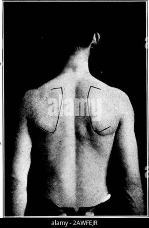Anatomia applicata e cinesiologia, il meccanismo del movimento muscolare . ullheight; ma il peso del solo braccio è un elemento comparativamente piccolo nel caso di coloro che non sono in grado di mettere il braccio di regolazione. In primo luogo non sono soprattutto gli individui più deboli a non compiere il movimento completo; il peso delle armature risulta più efficace in posizione orizzontale e presenta meno effectsoprastanti, mentre la difficoltà principale che questi soggetti sperimentano nell'aumentare il braccio non inizia fino a quando non risulta notevolmente più elevato rispetto al livello delle spalle; la difficoltà non viene rimossa eseguendo i capisquadra Foto Stock