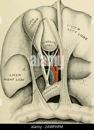 Intervento chirurgico operativo . vacuated prima o dopo aver sew-ing le pareti del tumore ai bordi della ferita abdominalwound. Operazione 27^6 (fissaggio primario e secondario della cistifellea alla parete ab-dominale) Dopo le precauzioni asettiche neces-sarie, Avitlithe paziente sdraiato sulla schiena, localizzare la cartilagine del tentrib e fare un'incisione fremita verso il basso e in avanti nel corso delle fibre del muscolo obliquo ex-esterno per tre o quattro pollici; Separare e separare le fibre del thismuscle e quelle dei muscoli riusciti-ing come appaiono {Greig p ,.,. ^ . , , . , , Smith); p Foto Stock