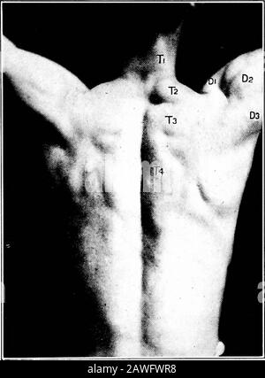Anatomia applicata e chinesiologia, il meccanismo del movimento muscolare . Fig. 33.- -postura anormale della scapola destra a causa della perdita del trapezius destro.(Mollier.) abbiamo notato che la prima parte del trapezius è mirabilisituata per sollevare le spalle, e che quando viene stimolata corrente elettrica lo fa prontamente. Quando si scusi le spalle, quindi, è naturale dedurre che aiuta nel movimento, la butosservazione del tipo che stiamo considerando ora dimostra che non doesnothing del genere, rimanendo in completo relax mentre il themovement è in esecuzione. Per provare questo w Foto Stock
