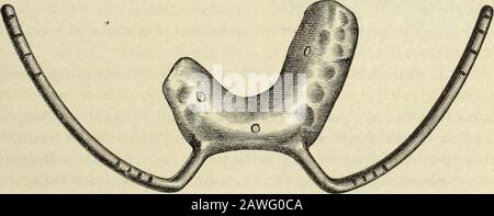 Il cosmo dentale . Fig. 9. - modello che mostra lo spostamento. 15 Maggio. Le impressioni sono state prese in gesso di Parigi preparatoria tomaking uno splint interdentale (Fig. 9). Questo è stato costruito in modo simile a quelli già descritti, con l'aggiunta di due fili d'acciaio (oldescavatrici) vulcanizzati nella stecca e curvi verso l'alto come è emerso dagli angoli della bocca, evitando così la pressione sulla Fig. 10..., e che si estende all'indietro quasi all'angolo della ganascia (Fig.10). Una fascia di gomma è stata sostituita per il bendaggio, ed è stata estendiata da un filo di acciaio sotto la ganascia all'altro, all'esterno del gugta-perch Foto Stock