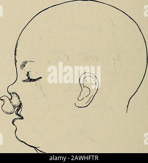 Chirurgia operativa, per studenti e professionisti. Segmento di elip può essere assente, insieme con l'osso intermascellare e thevomer. In questo caso il labbro superiore presenta uno spazio ampio e mediano, che si apre nella cavità nasale. La pulizia del Processo alveolare. - Con l'hrelip, come già effettuato da uomini, può anche essere presente una fessura del processo alveolare, e 174 TESTA E FACCIA. Ciò può variare da una fessura stretta e incompleta ad un ampio spazio aperto; può essere nnilaterale o doppia, ed è solitamente associata al palato senza fessura. Se non vi è alcuna sfaldatura del palato duro, la sfaldatura del processo alveolare te Foto Stock