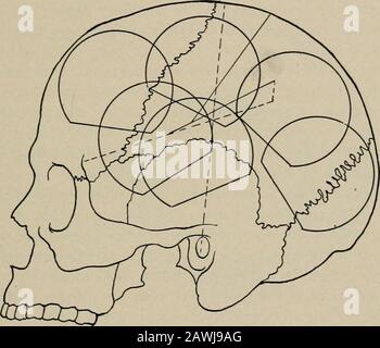 Chirurgia operativa, per studenti e professionisti. Ofscalpo suturato in posizione senza drenaggio. (Vedere La Fig. 61.) Metodo Craniotomico, Osteo-te^Flap.. Per esporre le parti dif-ferenti del cervello allo scopo di rimuovere i tumori, la posizione del flap varierà a seconda della posizione di thelesion. Un grande progresso nella chirurgia del cervello è stato reso pos-sible dall'introduzione del metodo di operazione del lembo osteotegumentale SULLA TESTA. 83 aprire il cranio e comprendere meglio i metodi di localizzazione dei processi che interessano particolari aree del cervello. Operat Foto Stock