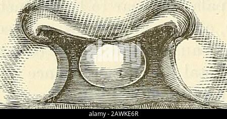 Un sistema di chirurgia : teorica e pratica . od. Si osserverà in alcuni casi che il gapsthrough della cresta alveolare è eccessivo, cioè com-plete dalla bocca alla narice; mentre in altri casessi sono ma parziali. Quando la fessura è eccessiva, e quando è completa attraverso il palato duro e softpalate, l'osso intreimascellare, o os incisivum, si separa spesso dalle superiori maxillae, e forma un nodulo più o meno rotondo/rWrf^^^ ^-^i: ^ - (thie lobo a ferro di cavallo della vita fetale già descritto), che è supportato da e fissato alla terminazione ante-rior inferiore del sep Foto Stock