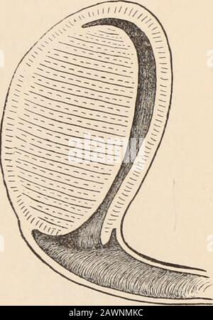 Archivi di medicina : una rivista bimestrale dedicata alle comunicazioni originali su medicina, chirurgia, e loro rami speciali. il ixwas grandemente ingrandito e deprimono-ed. Attraverso il os poteva sentire la superficie dura e liscia di un t=&gt;§§§§5:fibroide. L'impressione lasciata in su-sulla mia mente da un'ex-aminazione molto attenta di questo caso su Twooccations sarà trasmessa da questo diagramma, che come il restof naturalmente non deve essere regardedas completamente accurato. Ogni chirurgo conosce tutti questi casi willriconoscerà in questo personaggio di maggiore temibile, che l'Atlee avrebbe trattato con l'incisione, Foto Stock