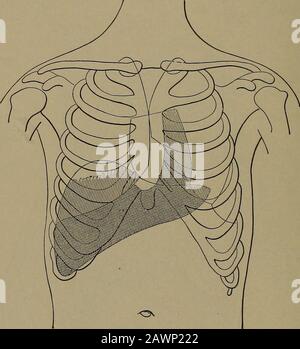 Diagnosi fisica, comprese le malattie degli organi toracici e addominali : un manuale per studenti e medici .. . Oeep consolidamento Seduto mascherato da V Emplysatematous Lung Localizzato EmphenfisemaCompensatorytoConsolidation(Dulness) Dulness con risonanza di qualità timpanitica. Se lo spostamento dell'aria è completato allora la percussione di quella parte del polmone sarà sistema RESPIRATORIO SIM- 96 TEE. Ilar a quello ottenuto su tutto il tessuto solido, airless, come coscia o fegato, E il suono sarà designato come piatto, è necessario che si renda una chiara distinzione sia tra dullness e planarità. Foto Stock